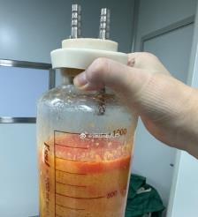 钟祥水动力吸脂手术要做多久？